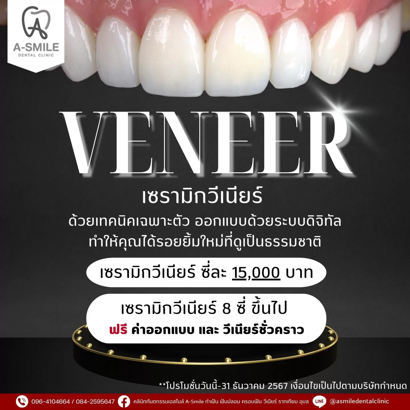 โปรโมชั่น วีเนียร์ อุบล,วีเนียร์ ส่วนลด, วีเนียร์ โปรโมชั่น