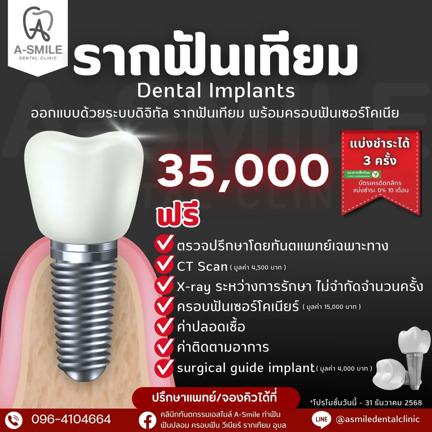 โปรโมชั่น รากฟันเทียม คลินิกทันตกรรม เอสไมล์ อุบล