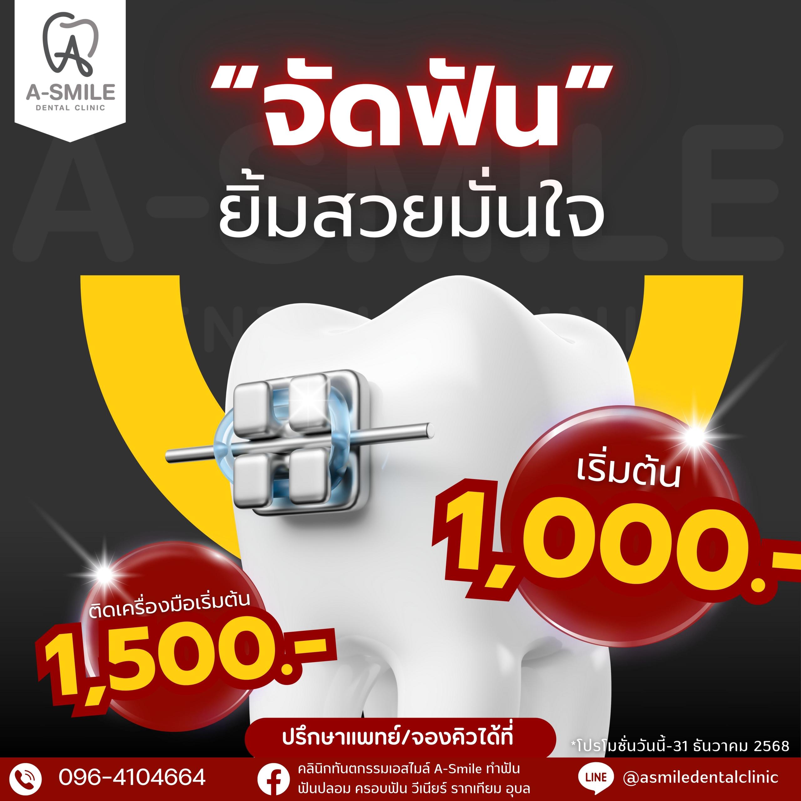 โปรโมชั่น จัดฟัน ติดเครื่องมือเริ่มต้น 1,500 บาท คลินิกทันตกรรม เอสไมล์ อุบล