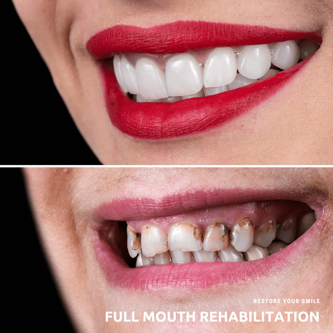 การบูรณะฟันทั้งช่องปาก อุบล